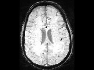 Cerebral Amyloid Angiopathy