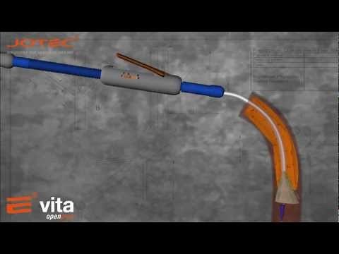 FROZEN ELEPHANT TRUNK WITH DEBRANCHING TECHNIQUE: ALTERNATIVE MANAGEMENT OF COMPLEX AORTIC ANEURYSM