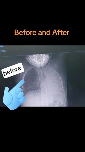 #pediatricsurgery #aspiration #foroegnbody #bronchoscopy #pediatricsurgeon