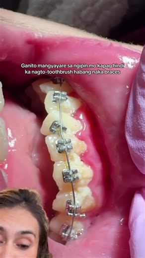 Essential Guide to Choosing a Toothbrush for Braces