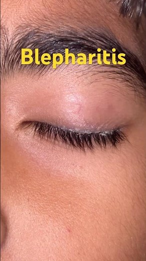 #blepharitis#eyes#lashes 🧐