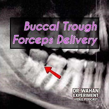 Erupted Wisdom Tooth Extraction