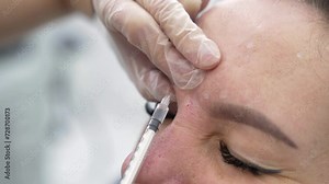 Beautician doctor makes botox injection in the forehead of young beautiful woman. Extreme close up 4k shot