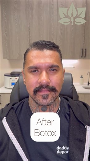 Boomer Banks Botox Before and After | Natural Facial Botox Results for Men