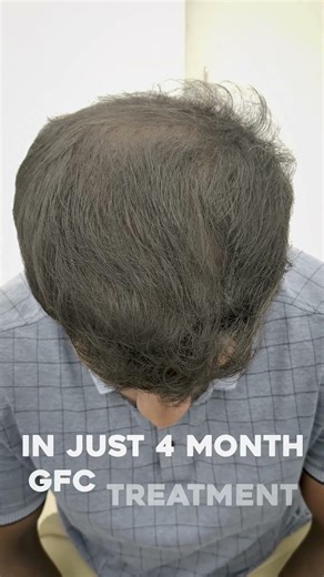 Real GFC Hair Growth Transformation 🤯🔥