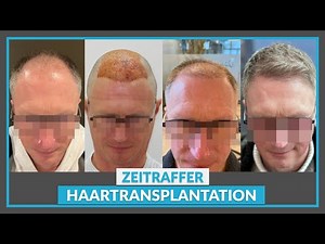 Zeitraffer nach Haartransplantation: 1 – 3 – 6 – 9 – 12 Monate [Wachstumsverlauf]