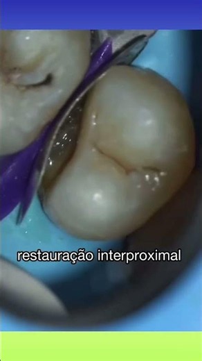 Interproximal Restoration #dental #dentalvideos #vaiprofy #fyvideos #fypシ゚viral #odontologo #odon...
