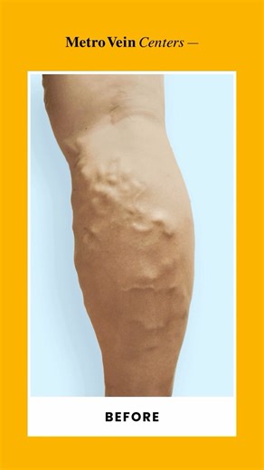 18K views · 70 reactions | Whether you're seeing bulging veins or...