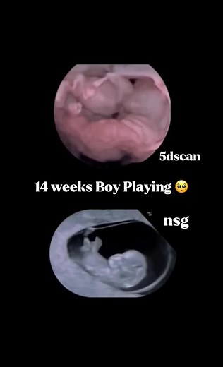 14 Weeks Baby Ultrasound Insights and Highlights