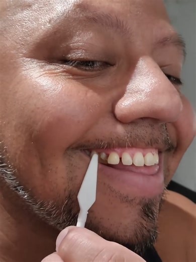 DO-IT-YOURSELF TEMPORARY TEETH REPLACEMENT PRODUCT: Hi 👋 Missing a tooth and need a temporary solution for appearance or comfort? Our Thermal Beads can be shaped to temporarily fill the gap until you see a dentist 😊 💰K350 per pack 📞 260973306830 📍 Lusaka, Zambia Country wide Delivery Available FITTING INSTRUCTIONS: Pour plastic fitting beads into a cup of very hot water. Once the fitting plastic turns clear, remove it using a metal spoon. Shape the clear fitting plastic into a cylinder usin