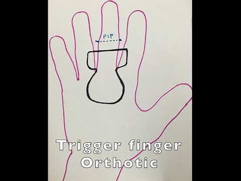 Trigger Finger Orthotic/Splint Fabrication in Hand Therapy Setting
