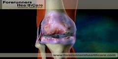 Animation of Knee Replacement