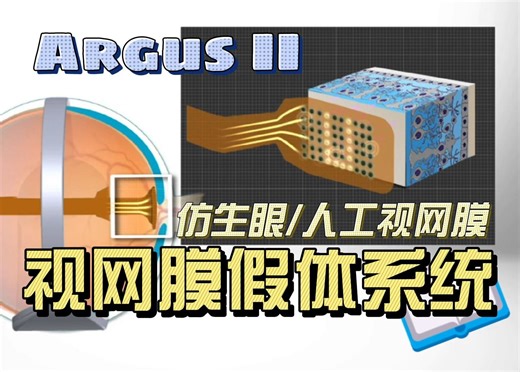 【中英丨视网膜假体】Argus II 人工视网膜（仿生眼/电子义眼）