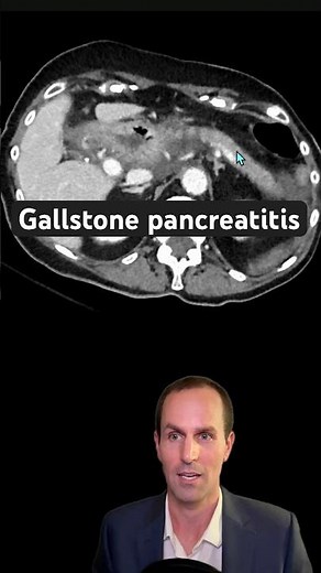 Abdominal CT Tutorials - Gallstone pancreatitis