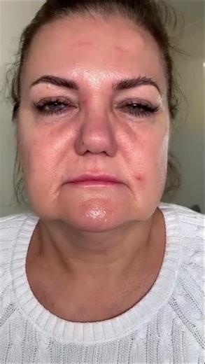 Facelift & Neck Lift