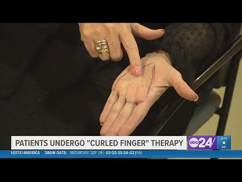 How radiation therapy can help people who suffer from Dupuytren's Contracture