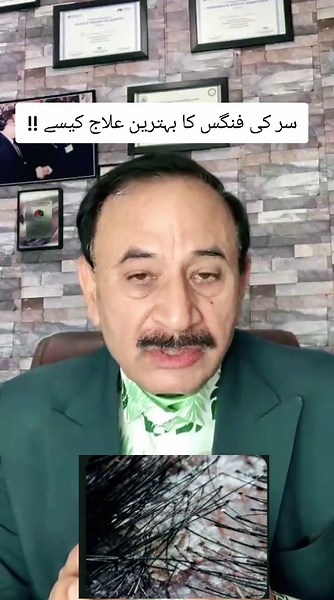 Effective Treatment for Scalp Fungal Infections