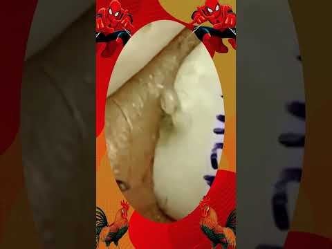 Satisfying Blackhead Removal | Acne Treatment, Pimple Pop & Deep Skin Clean-Up
