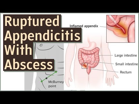 Ruptured Appendicitis with Abscess