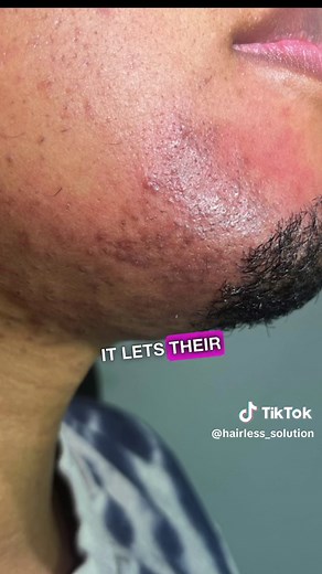 Electrolysis Treatment Progress and Results