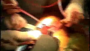 How I Put in a Cemented Femoral Component