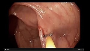 A Primer on Polyps: Identification, Description, and Resection