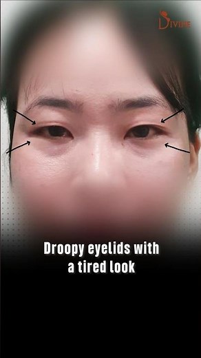 1 Month After Eyelid Surgery | Blepharoplasty Transformation Results