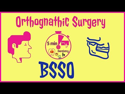 BSSO - BILATERAL SAGITTAL SPLIT OSTEOTOMY | ORTHOGNATHIC SURGERY | 5 min DENTISTRY easy notes