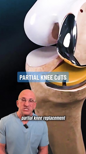 Partial Knee Replacement Bone Saw Cuts