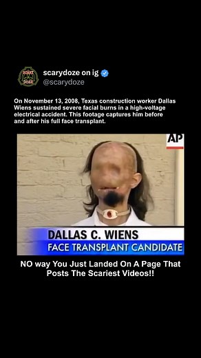 On November 13, 2008, Texas construction worker Dallas Wiens was severely injured when his head accidentally touched a high-voltage power line while working on a church. He suffered massive facial burns, losing his eyes, nose, lips, and eyebrows. After dozens of surgeries, in 2011, Wiens became the first person in the U.S. to receive a full face transplant, a groundbreaking 15-hour procedure performed at Brigham and Women's Hospital in Boston. The incredible footage documents his transformation 