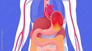 Anatomical 3D animation of the digestive system with burning and heartburn. About a human silhouette and internal organs in flat colors. Seen from the front on a blue background. Stock Video
