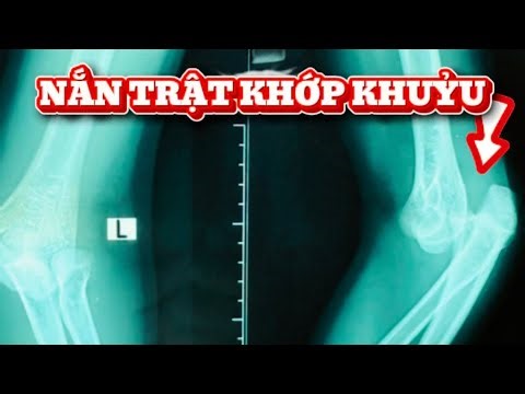 Elbow dislocation reduction (Eel Dislocation Reduction) @DrHuyB83