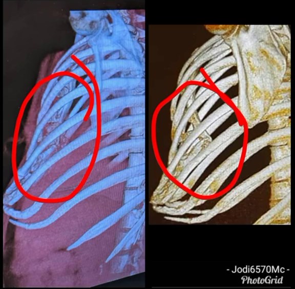 Before and After: Pectus Correction with Ravitch Procedure
