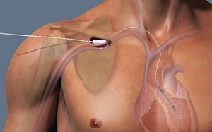 短期机械辅助装置Impella原理及视频演示