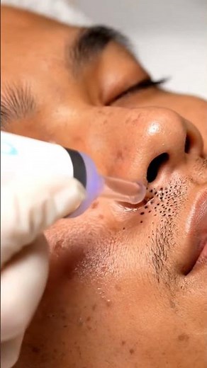 ASMR Nose & Cheek Deep Pore Extraction | Gentle Blackhead Removal & Spa Relaxation