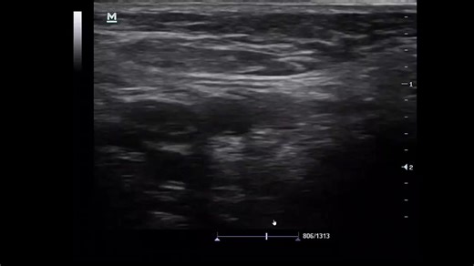 The great value of U/S in central line insertion. Register in our recorded online course to learn so many critical care U/S tricks which will change your way of management and boost your ICU skills. We are continuously upgrading our courses., so you will expect new lectures to be added to your course from time to time. Attention please, now the complete Lower Limb arterial and venous Doppler course is added to our recorded critical care U/S from basic to advanced course. Also, this week 10 new l