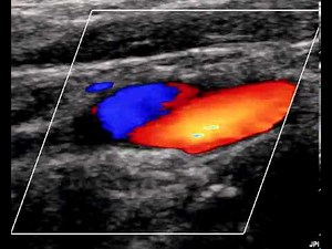 INTERNAL CAROTID ARTERY DISSECTION