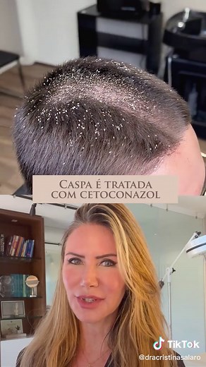 Você sabe o que é isso? É dermatite seborreica (ou caspa). O shampoo à...