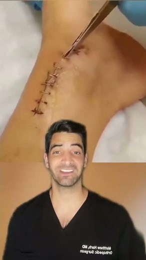 Staple Removal