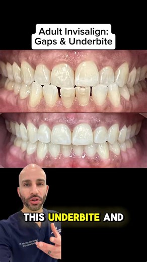 Adult Invisalign to Fix Underbite and Gaps (Fort Lauderdale Orthodontist)