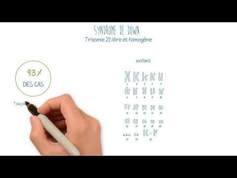 Trisomie 21 : prévalence et mécanismes génétiques