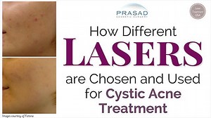 How to Select the Best Laser Treatment for Cystic Acne