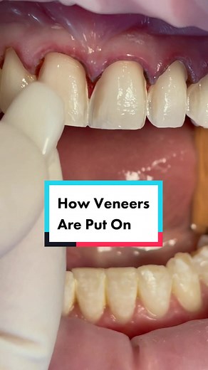 Understanding the Process of Placing Veneers on Teeth