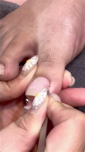Extreme Close-Up Ingrown Toenail Removal #nails #nailasmr