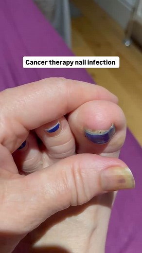 90% of cancer patients experience nail damage during treatment — but only 41% even know it can happen 💔💅 Why aren’t we talking about this more? 🗣️✨ Nail toxicity can cause pain, infection, and a huge emotional impact, yet it’s one of the most under-discussed side effects of treatment. At Polybalm, we’re on a mission to change that. Backed by clinical studies, Polybalm offers a natural, effective way to help protect repair nails during chemotherapy, improving comfort and confidence. 💚 We’ve a