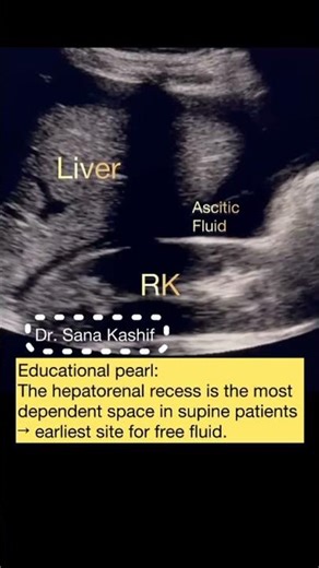 Fast Ultrasound: Free Fluid in hepatorenal recess #radiology #ultrasound #ardms #asar #scfhs #fast