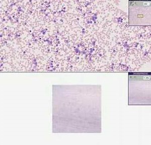 Histopathology Blood --Chronic myelogenous leukemia