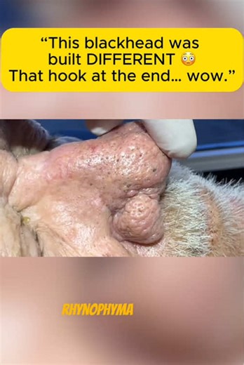 See the blackhead that ALMOST defeats. Have you ever seen a blackhead with a hooked bottom!? #blackhead #extraction #oddlysatisfying #pimplepopping #satisfyingvideo