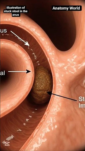 Illustration of a well-labelled stuck stool in the anus