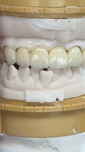 Full mouth rehabilitation case from Texas! Dr.Andre Jones | CEO Luke Kahng